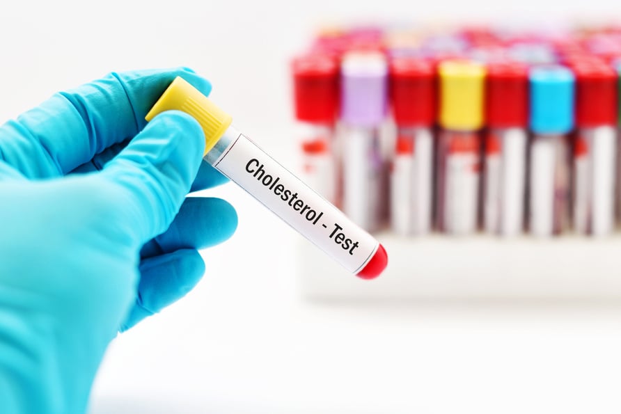 Hand Holding a Citrate Tube Labeled Cholesterol Test 